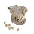 2021 New Dental Disease Implant Teeth Model with Restoration Bridge Tooth Dentist for medical Science Disease Teaching Study