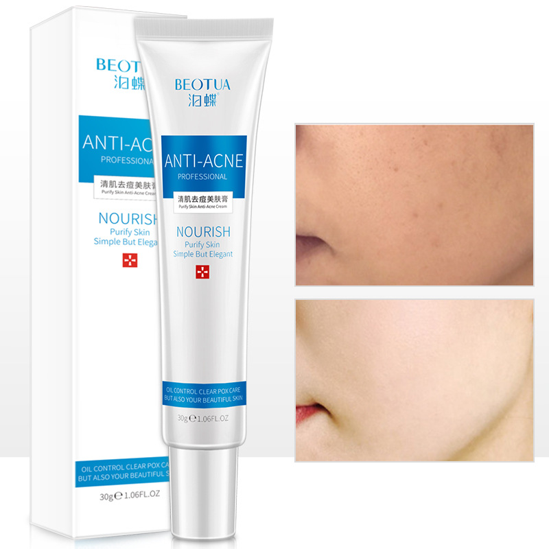 30g Acne Treatment Blackhead Remova Anti Acne Cream Oil Control Shrink Pores Acne Scar Remove Face Care Whitening TSLM1