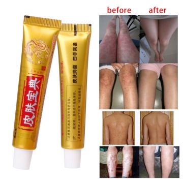 Natural Chinese Medicine Herbal Anti Bacteria Cream Psoriasis Eczema Ointment Treatment