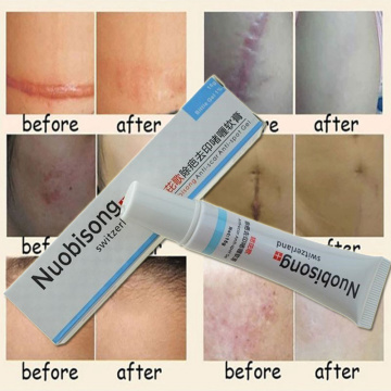 New Arrivals Nuobisong face care acne scar removal cream Acne Spots skin care treatment whitening face cream stretch marks