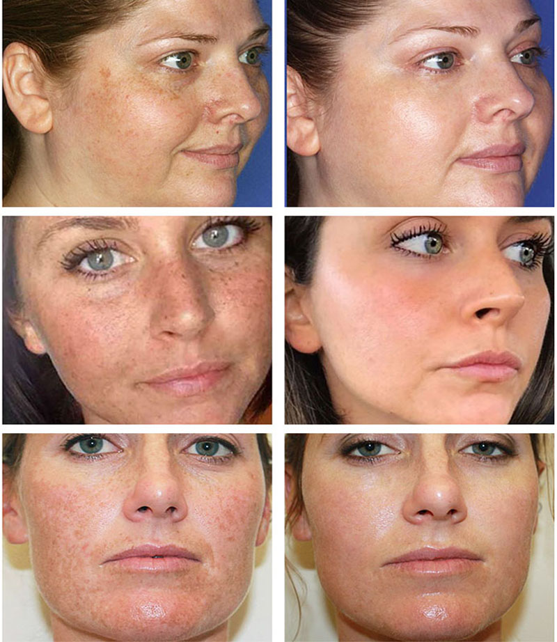 FAIR KING Hyaluronic Acid Moisturizing Nourishing Brighten Skin Arbutin Whitening Fade Reduces Dark Age Spot Freckles Face Cream
