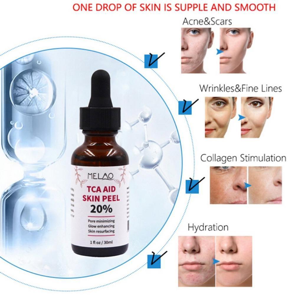 30ml Trichloroaectic Acid 20% Skin Peel Pore Minizing Wrinkles Spots Skin Care Face Serum