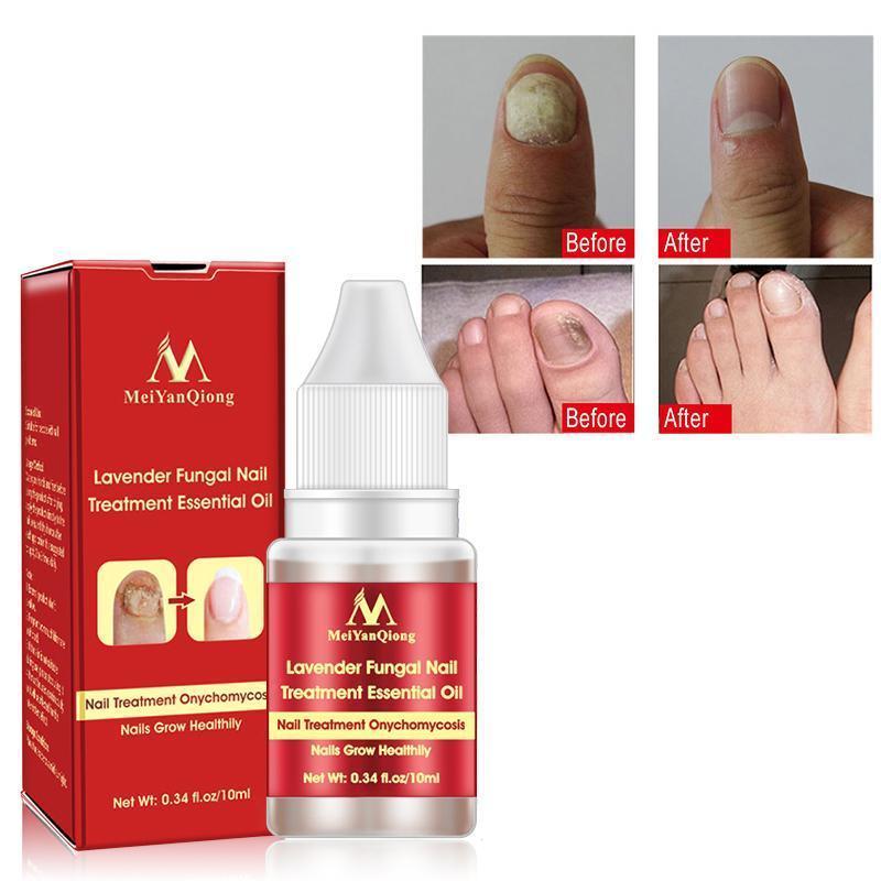 New Chinese Cream Nails Finger Toe Protector Fungus Treatment Herb Health Tools Onychomycosis Paronychia Infection Skin Care