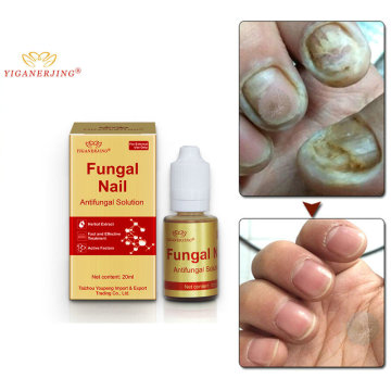 Fungal feet Treatment Care Essence Foot Whitening Toe Nail Fungus Removal Gel Anti Infection Paronychia Onychomycosis