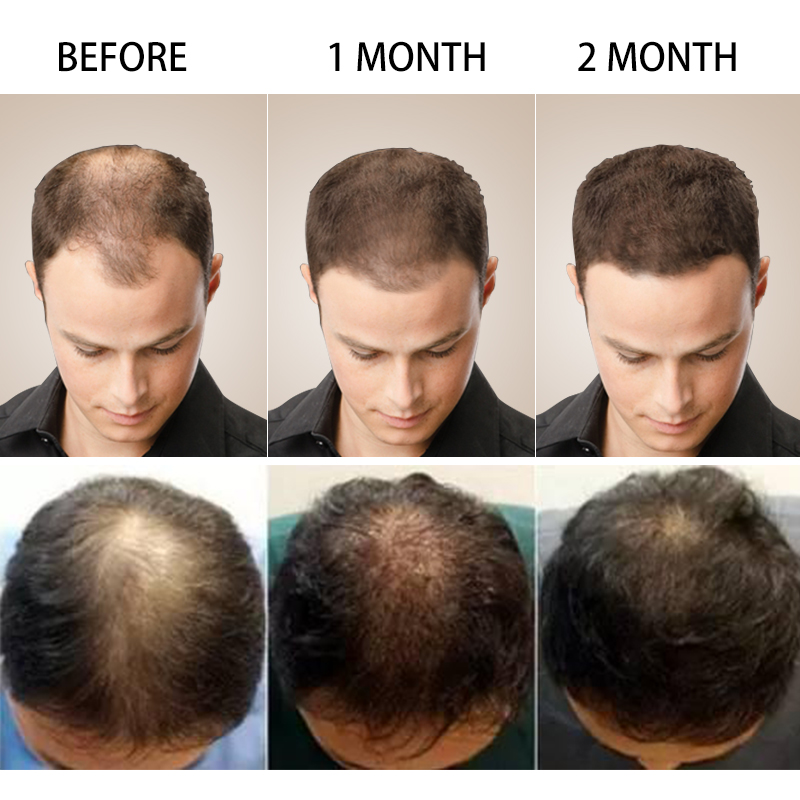 Putimi Natural Hair Growth Essence Anti Hair Loss Serum Health Care Dense Beard Hair Growth Serum HairCare Regrowth Treatment