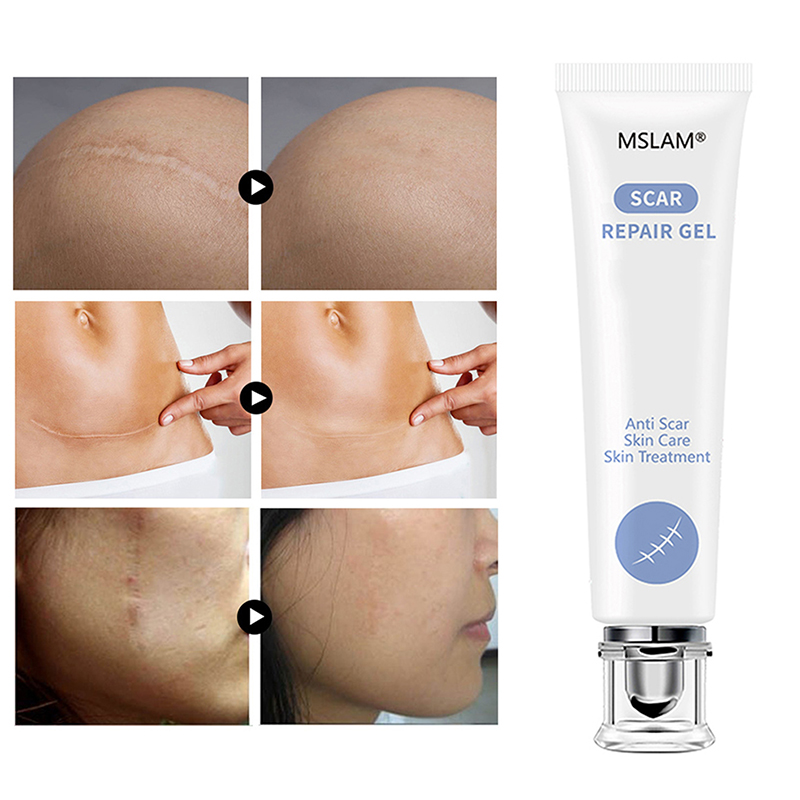 Scar Repair Gel Removal Scar Acne Cream Face Pimples Stretch Mark Cream Repairing Smoothing Whitening Body Cream Skin Care TSLM1