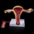 Human Pathological Uterus Ovary Model Anatomical Anatomy Disease Pathology Medical Lesion For Teaching Dropshipping