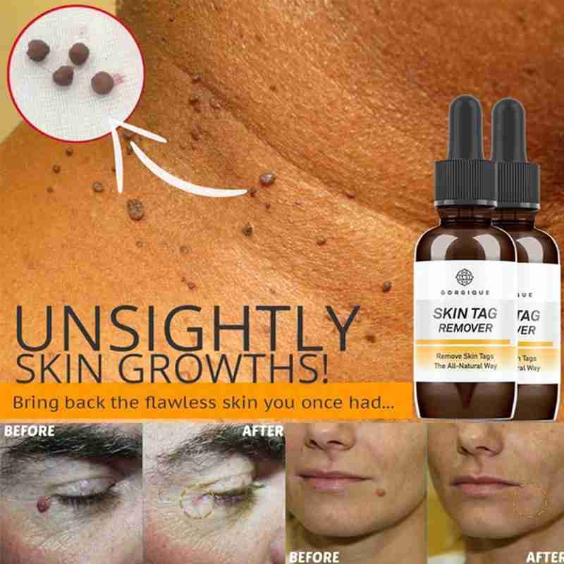 10/20/30ml Skin Tag Remover Mole Foot Corn Wart Care Pure Acid Essence 100% Essence Hyaluronic Serum Natural Oil