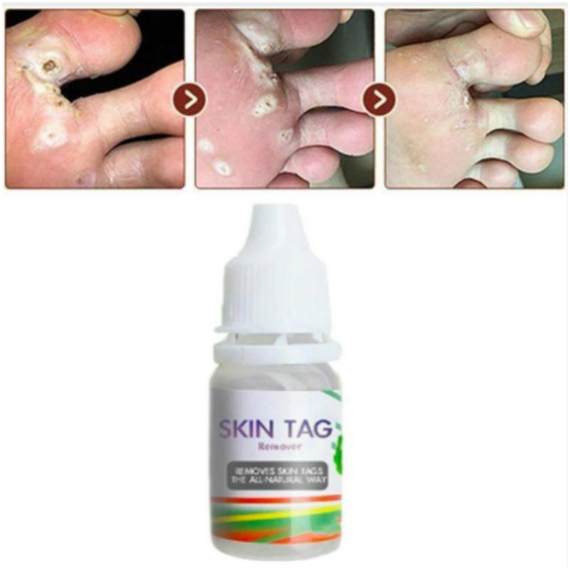 Skin Tag Remover Corn Eye Treatment Solution Corns Exfoliator Callus Removal Liquid Foot Skin Care Product