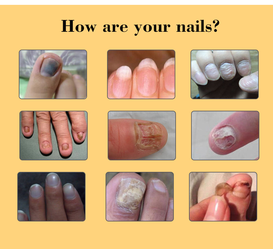 1 Pc Hands Feet Nail Care Whitening Toe Nail Fungal Fungus Removal Anti Cream Nourishing Repair Tool TSLM2
