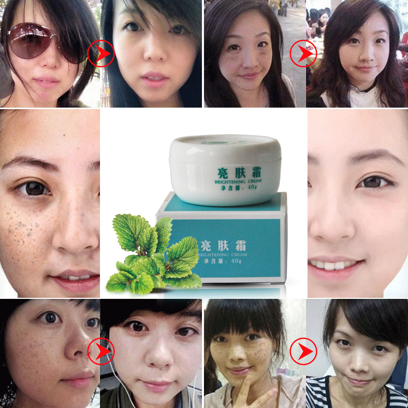 Powerful whitening Freckle removal cream melasma Acne Spots pigmention crem for face