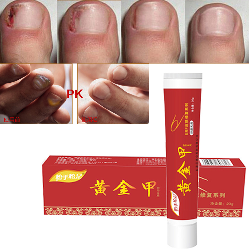 No Box Foot Skin Care Fungus Nail Treatment Cream Onychomycosis Paronychia Anti Fungal Nail Infection Fights Bacteria