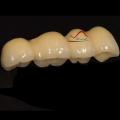 PFM Dental Implant Bridge
