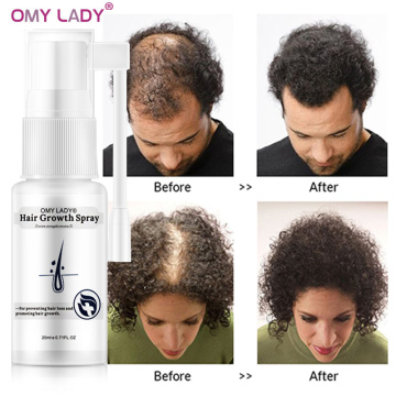 OMY LADY Fast Hair Growth Serum Anti Hair Loss Spray Essential Oil Liquid For Men Women Dry Hair Regeneration Repair Hair Loss