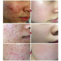 Acne Treatment Face Serum Centella Asiatica Oil Control Shrink Pores Scar Essence Whitening Moisturizer Skin Care Essence Serum