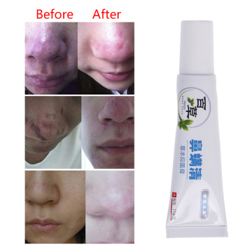 15g Nose Cleaning Cream Rosacea Treatment Cream Nose Redness Removal Cleaning Antibacterial Gel Skin Care Product