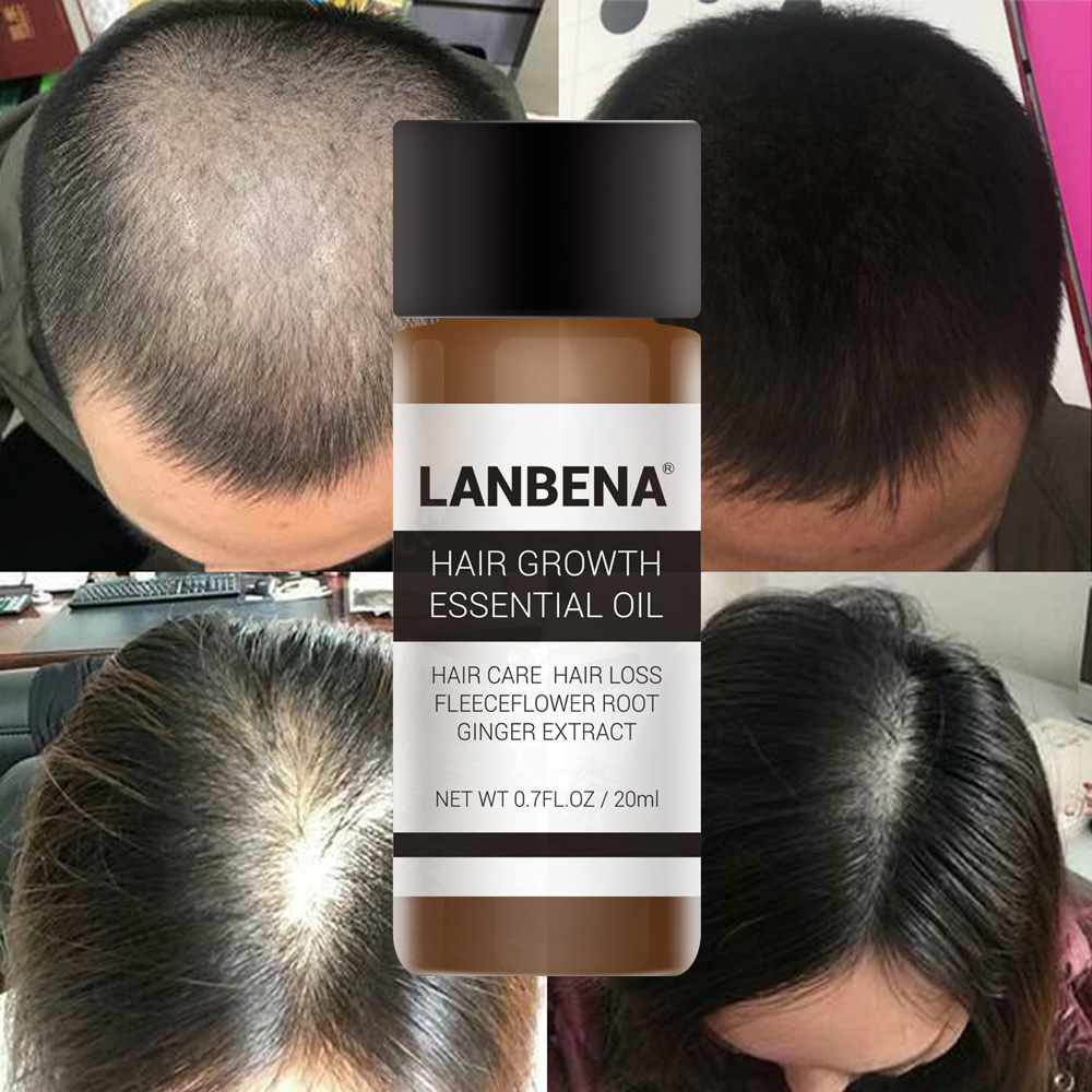20ml LANBENA Anti Hair Loss Essence Fast Hair Regrowth Product Pilatory Hair Care Essence Hair Fiber Restoration Anti Bald Serum