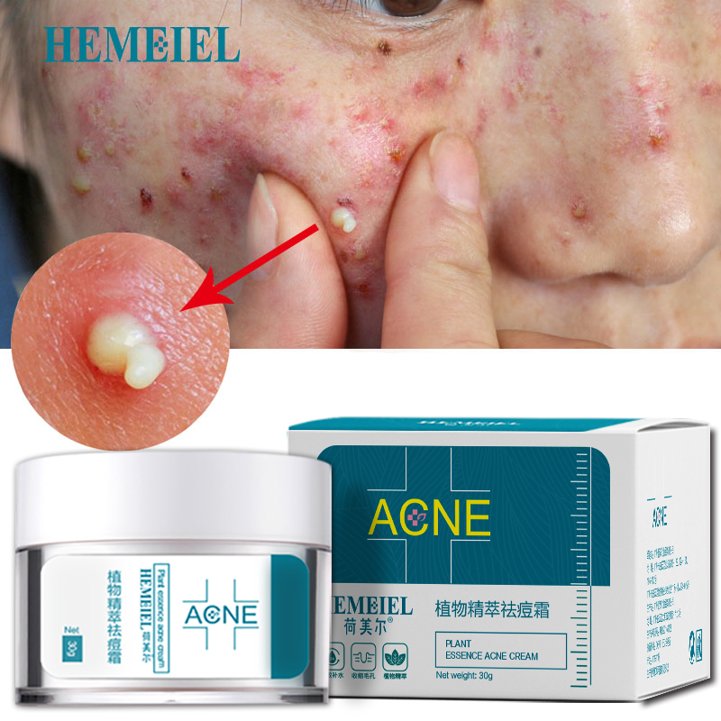 Hemeiel Acne Cream Acne Treatment Anti Pimples Spot Acne Scars Blackhead Removal Cream Beauty Skin Face Care Whitening Creams