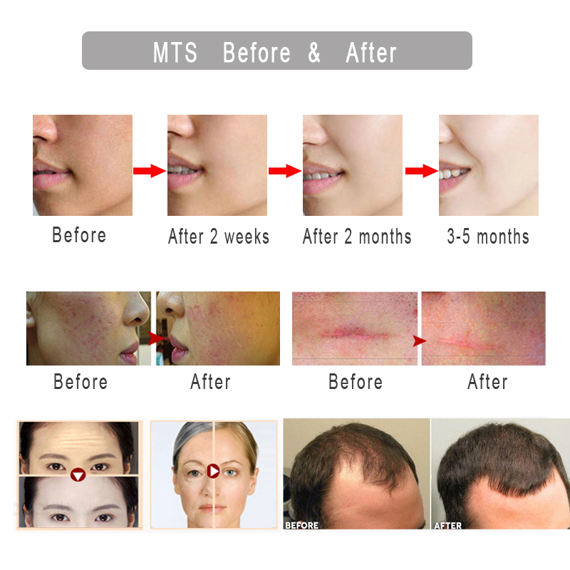 Derma roller DRS540 Mezoroller Micro Needle Face Skin Care Hair Regrowth Beard Growth Anti Hair Loss Treatment Thinning Receding