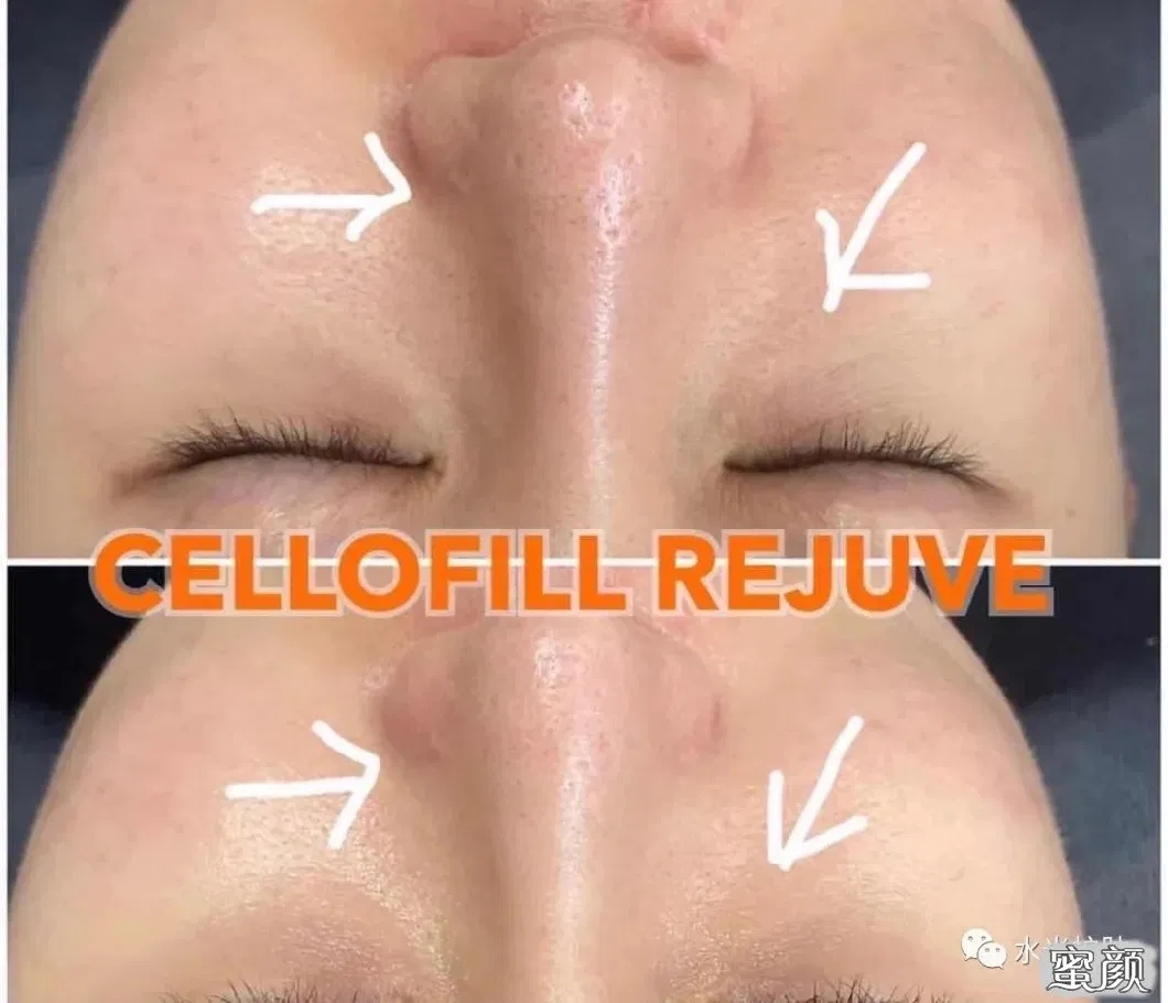 2022-New-Top-Selling-Korea-Origin-Chanel-Cellofill-Rejuve-for-Skin-Face-Reguventing-Anti-Aging-3ml-6vials-Skin-Booster-Dermal-Filler-Injection.webp (5)