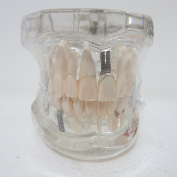Dental materials Oral removable dental pathological model Special decoration Clinic personalized decorative Figurines