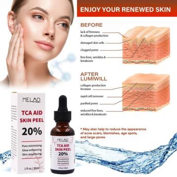 30ml Tca Aid Skin Peel Trichloroaectic Acid 20% Skin Care Wrinkles Minizing Pore Peel Face Skin Serum Spots O4N5