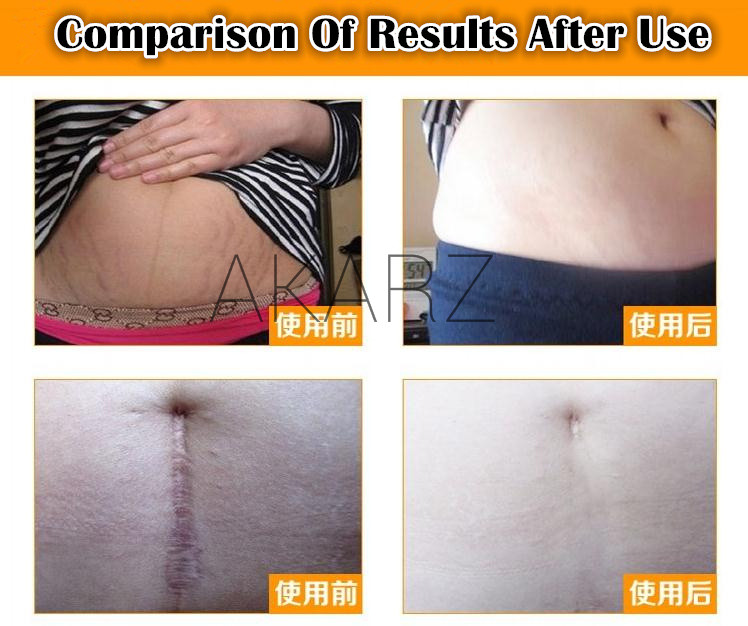 AKARZ Famous brand For Stretch Mark Removal Maternity Slackline For Pregnant Stretch Marks Remover Essential Oil Treatment oil