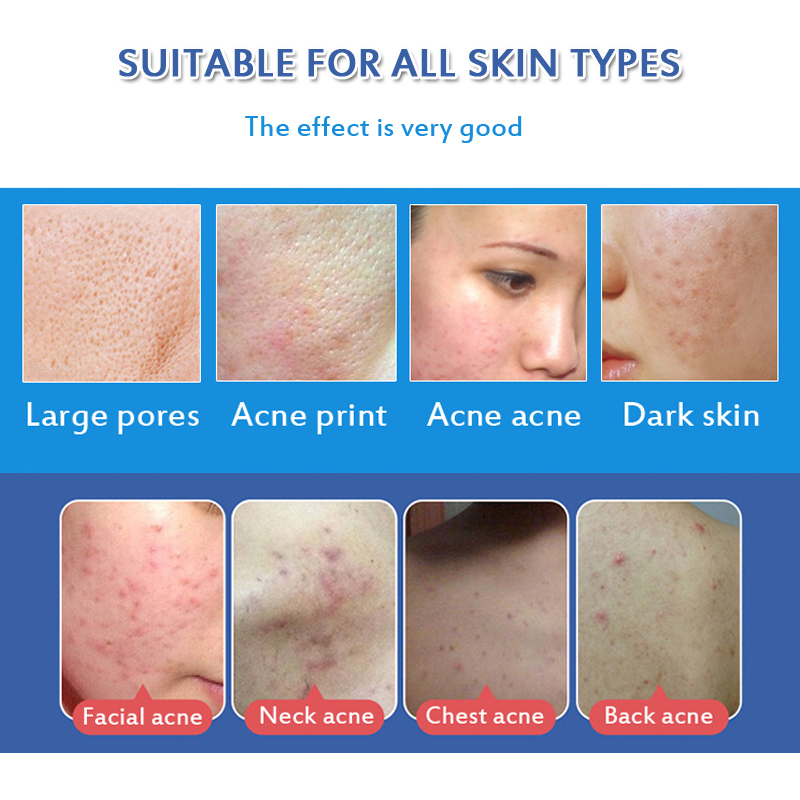 New Arrival Acne Cream Deel See Minral Face Serum Wrinkle Remover Against Black Dots Cream Skin Care Treatment Bleaching Cream