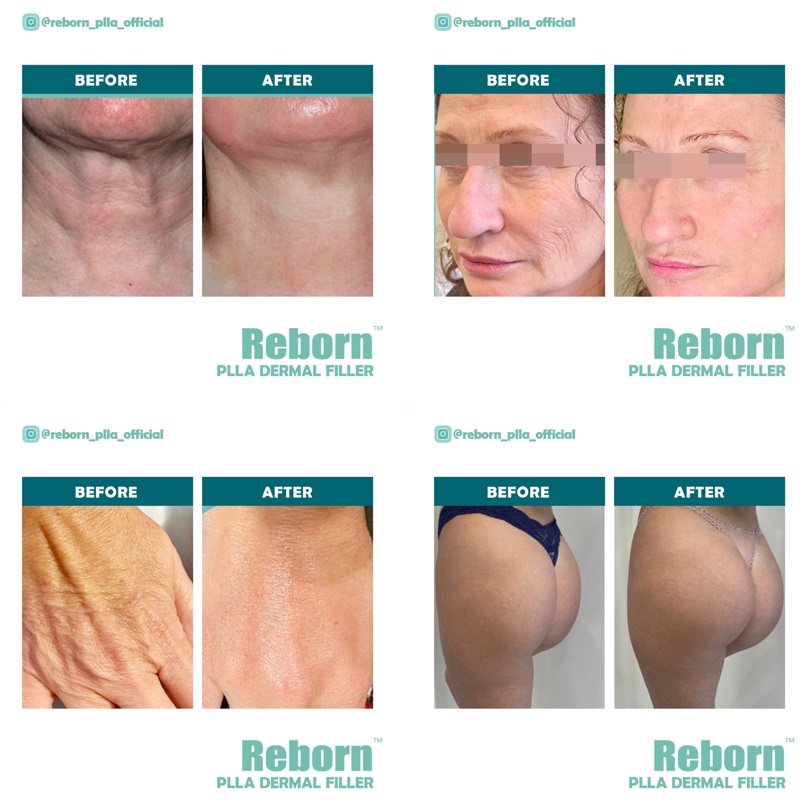 PLLA FILLER BEFORE AND AFTER