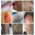 Body Cream Skin Care Psoriasis Dermatitis Itching Repair Body Eczema Antibacterial Treatment Psoriasis Cream Dropshipping