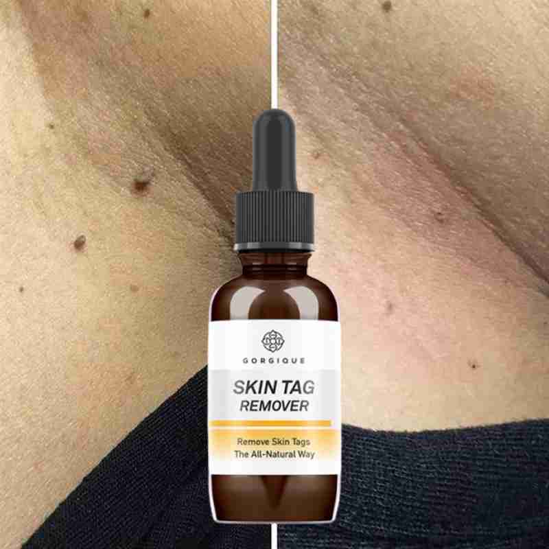 10/20/30ml Skin Tag Remover Mole Foot Corn Wart Care Pure Acid Essence 100% Essence Hyaluronic Serum Natural Oil