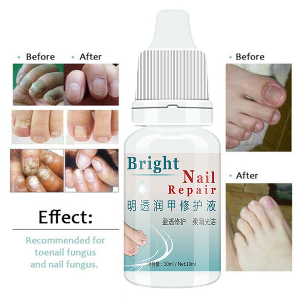 10ml Anti-fungal Cuticle Oil Nail Repair Treatment Toenail Strengthen Mint Brighten Oil Nai Growth Nail Fungi Fungus Manicu M0G1