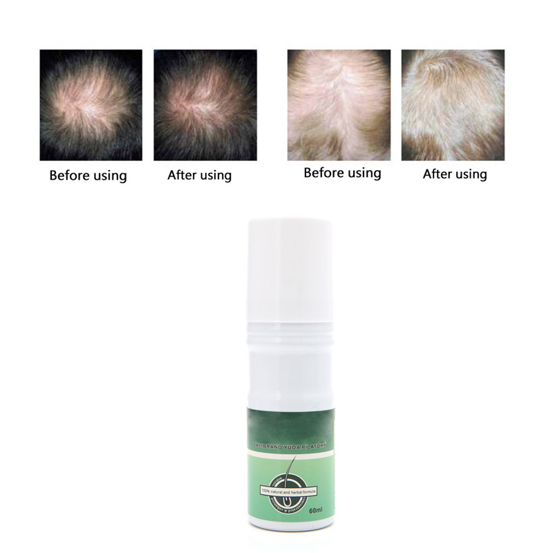 Yuda Pilatory Hair Regrowth Liquid Product Anti Alopecia Treatment Baldness 60ML 896D