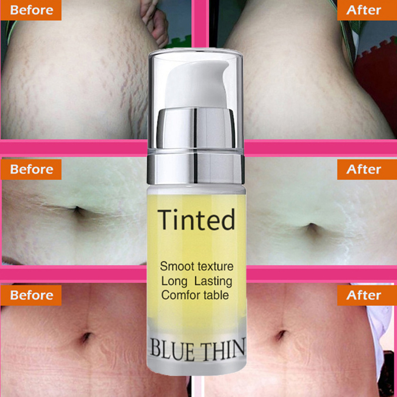 Stretch Marks Obesity Pattern Growth Pattern Repair Cream Removal Scar Marks Cream Treatment Nourish The Skin TSLM1