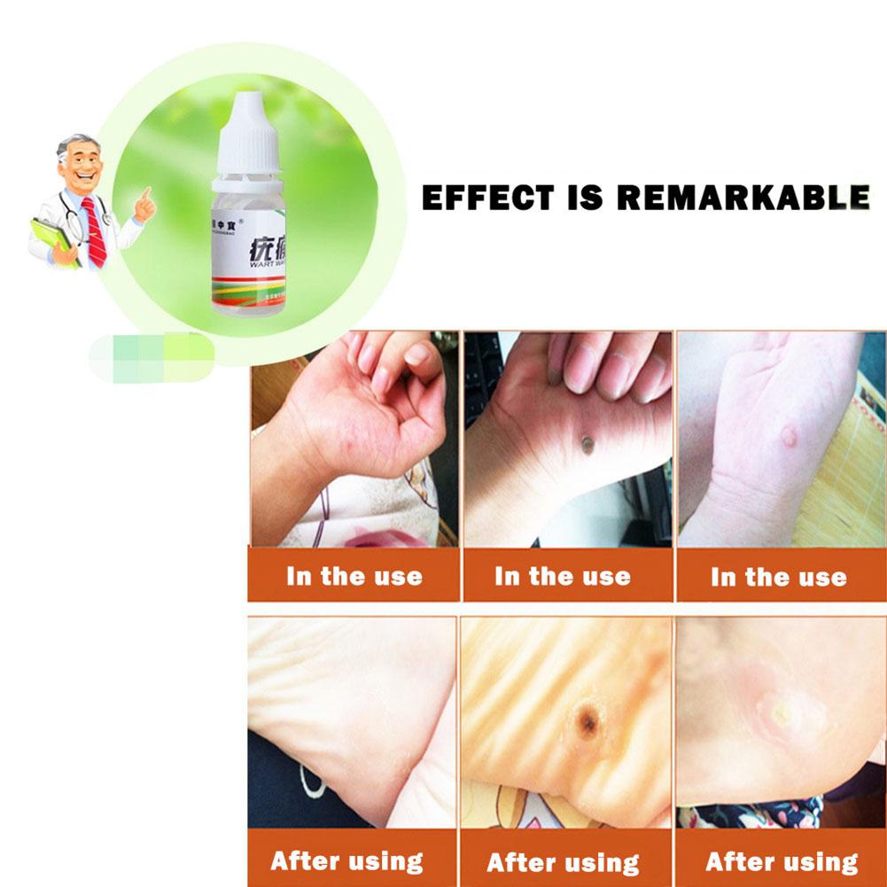 12 Hours Black Dots Mole Wart Skin Tag Remover Liquid Medical Corn Removal Foot Genital Care Mole Removal Papillomas Treatment