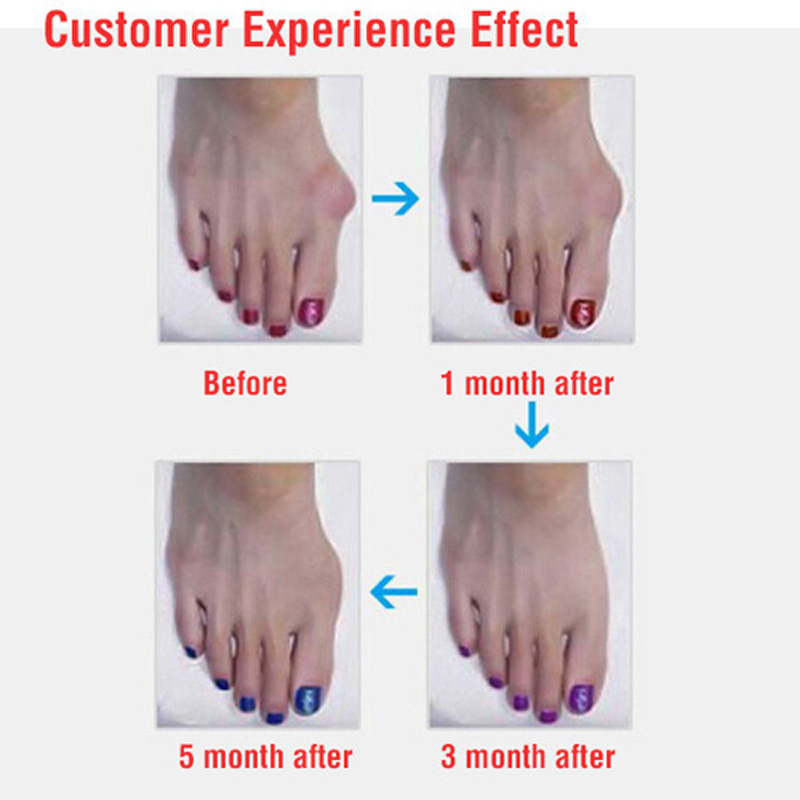 1pair=2pcs Silicone Foot Care Bunion gel Toe Separator Toes Ring Separation Hallux Valgus Correction Plantar Fasciitis Toes