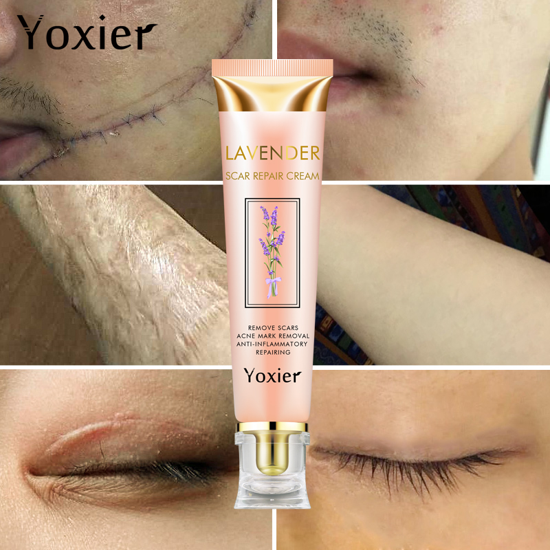 20g Remover Acne Scar Stretch Cream Marks Repair Acne Spots Acne Treatment Face Cream Blackhead Skin Care Whitening Cream