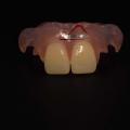 Dental Anterior Flexible Denture
