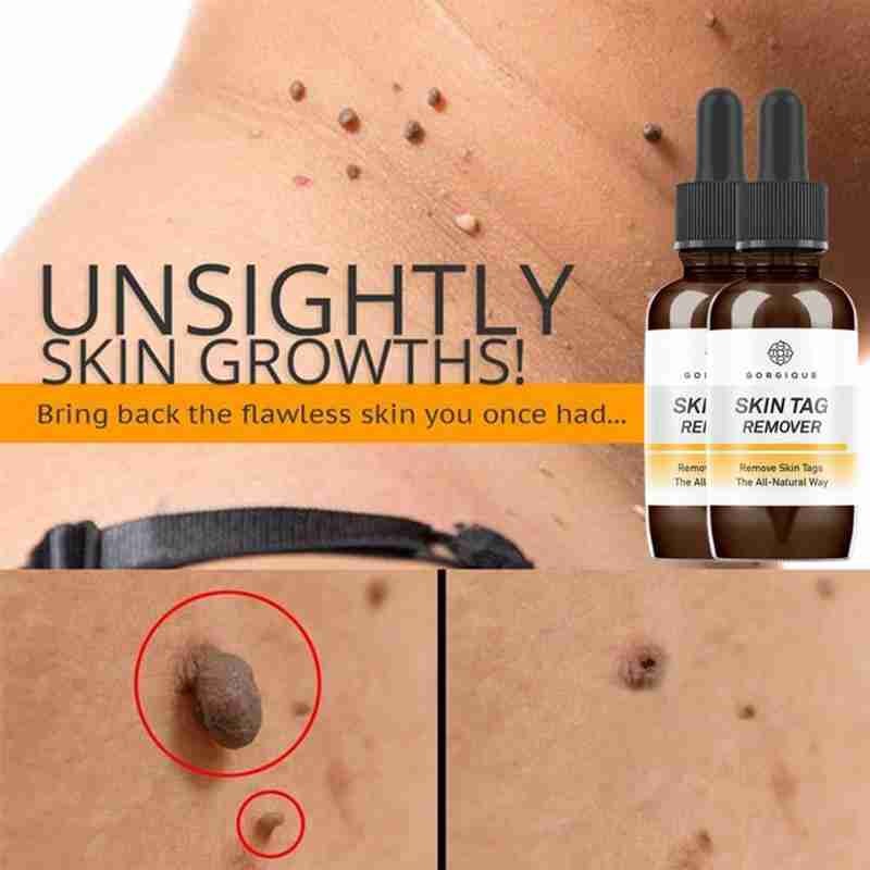 Skin Tags Warts Removal Essence Liquid Papillomas Removal Against Foot Corn Marker Wart Moles Genital Treatment Care Oil 10/30ml