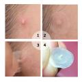 Acne Pimple Patch Effectively Remove Blackhead Pimple Remover Stickers Invisible Acne Treatment Mask Face Skin Care Beauty Tool