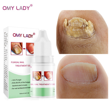 OMY LADY Fungal Nail Repair Essence Serum Toe Nail Fungus Treatment Nails Gel Anti Infection Paronychia Onychomycosis Nails Care