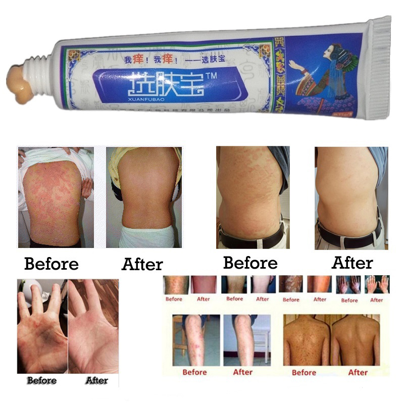 Body Cream Skin Care Psoriasis Dermatitis Itching Repair Body Eczema Antibacterial Treatment Psoriasis Cream Dropshipping