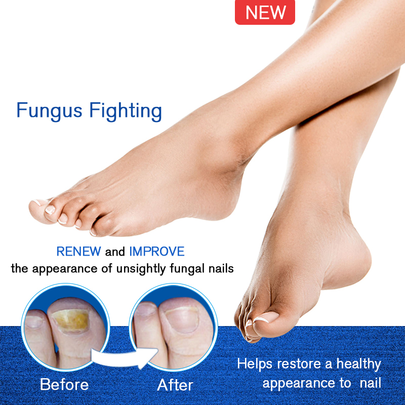 Fungal Nail Treatment Pen Fungal Nail Repair Remover Cuticle Oil Pen The Herb Bright Cream Disinfection Toe Nail Fungus Remover