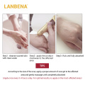 LANBENA Acne Scar Removal Face Cream Acne Spots Acne Pigmentation Corrector Anti Scar Stretch Marks Repair Skin Care 30G