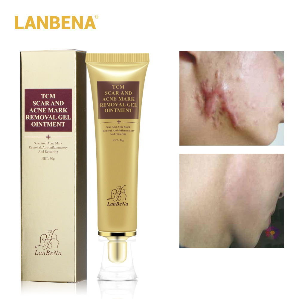 LANBENA Acne Scar Removal Face Cream Acne Spots Acne Pigmentation Corrector Anti Scar Stretch Marks Repair Skin Care 30G