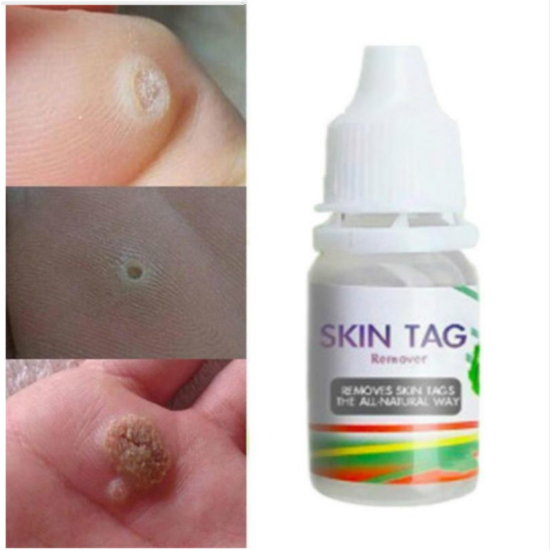 Skin Tag Remover Corn Eye Treatment Solution Corns Exfoliator Callus Removal Liquid Foot Skin Care Product