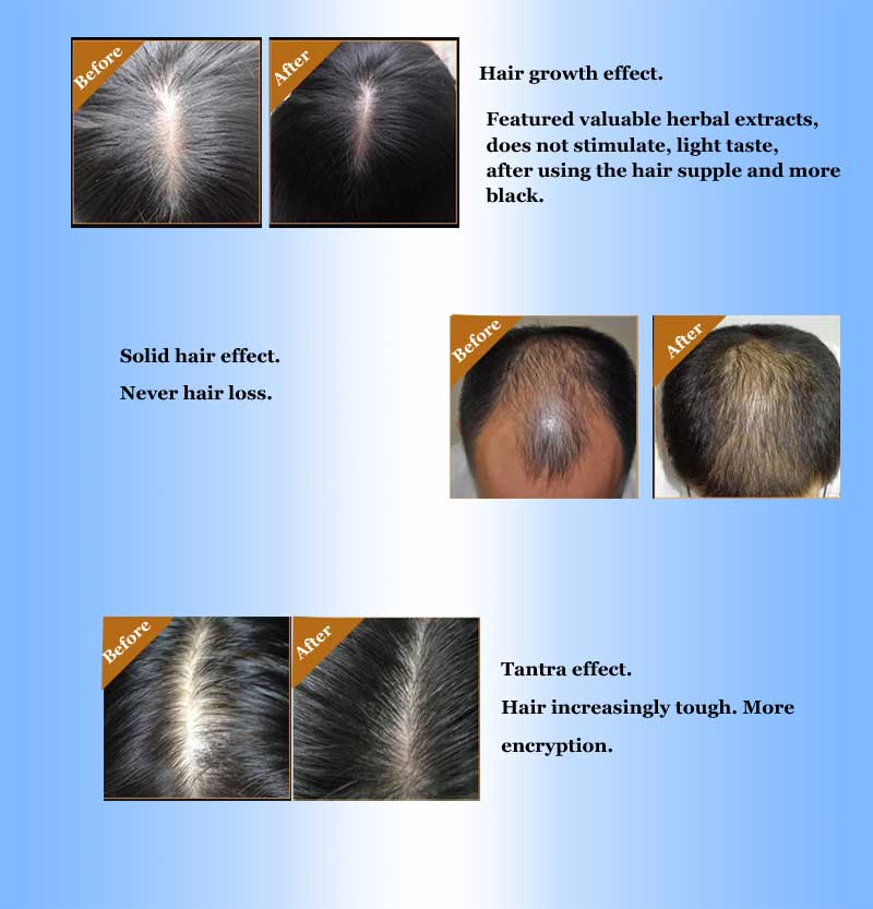Okeny's Ginger Andrea Hair Growth Essence Oil Fast Grow Dense Restoration Anti Hair Loss Product Sunburst Alopecia for Woman Man