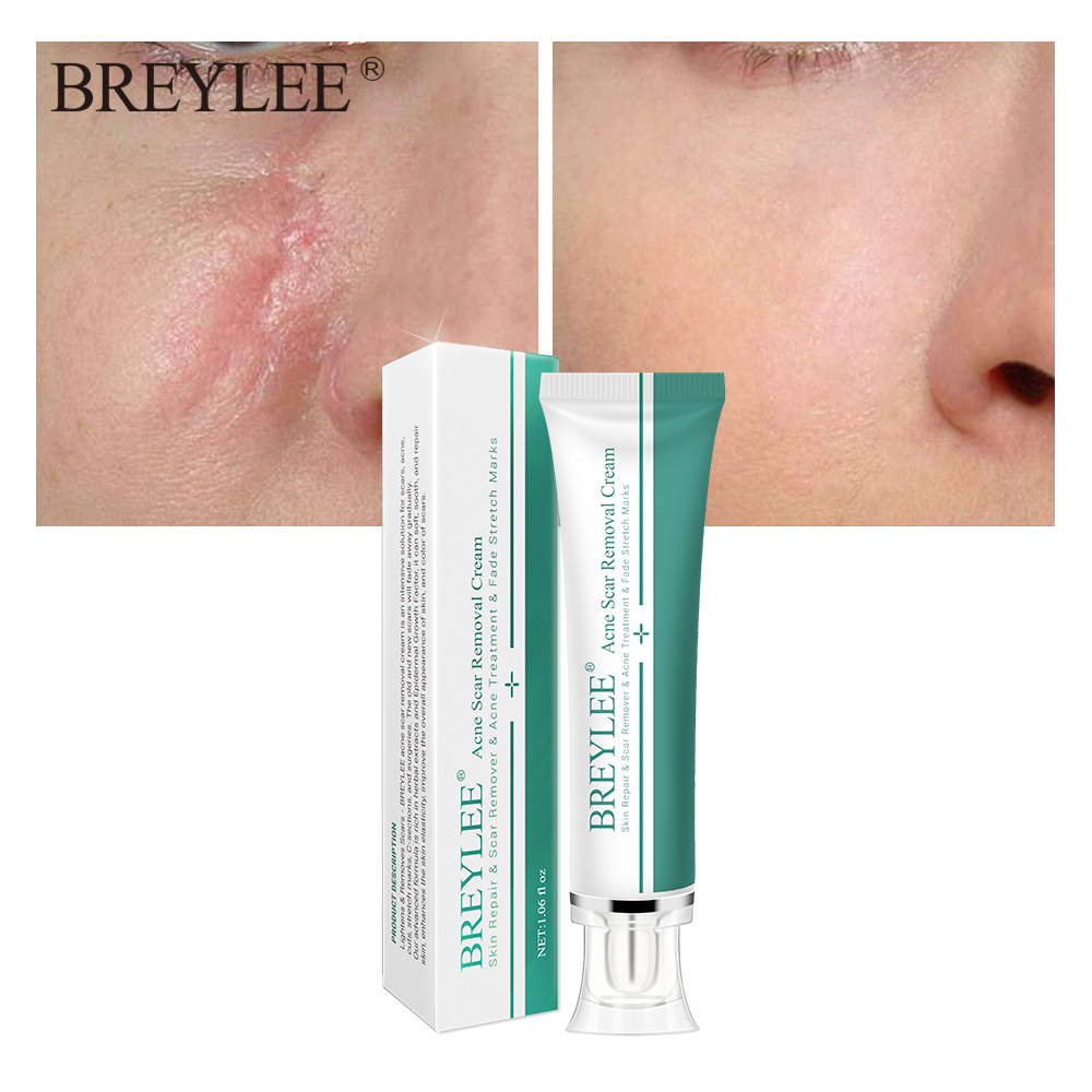 Removal Scar Cream Face Pimples Scar Stretch Marks Removal Acne Treatment Whitening Moisturizing Cream Skin Care