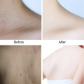 LAIKOU Body Scrubs Exfoliating Scrub Deep Cleansing Pores Acne Treatment Body Skin Whitening Cream Dead Skin Removal Skin Care