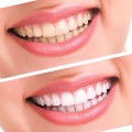 Teeth Whitening 44% Peroxide Dental Whitening System Oral Gel Kit Tooth Whitener Protection 10Pcs/Set